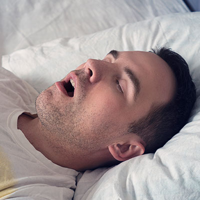Primer plano de un hombre durmiendo con la boca abierta, mostrando dificultad para respirar y ronquidos, síntomas típicos de la apnea del sueño.